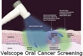 Velscope Oral Cancer Screening